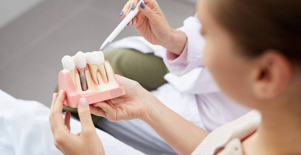 ¿Cómo se hace un implante dental? Todo lo que necesitas saber para la aplicación de implantes dentales